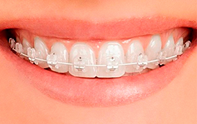 Ortodoncia brackets esteticos Dra. Karina Orta